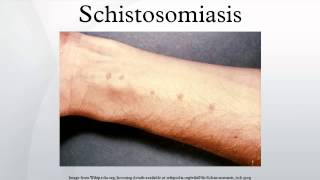 Schistosomiasis [upl. by Arymas]