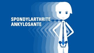 Questce que la spondylarthrite ankylosante [upl. by Eustatius]