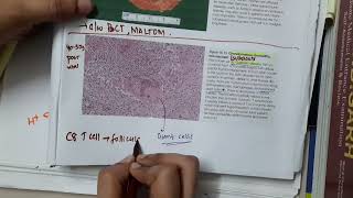 granulomatous thyroiditis  Pathology [upl. by Annauqahs]