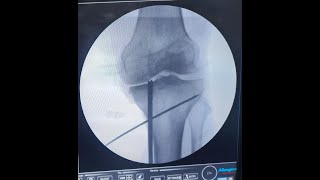 MEDIAL MENISCUS ROOT TRANSTIBIAL PULL OUT REPAIR [upl. by Mixam]