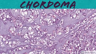 Chordoma 5Minute Pathology Pearls [upl. by Rowan]