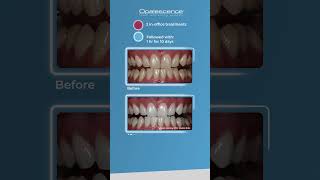 Opalescence™ Boost™ and Opalescence™ PF  Case Study [upl. by Hsotnas]