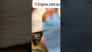 Cracked heels callus hard skin removal by podiatrist [upl. by Chavey959]