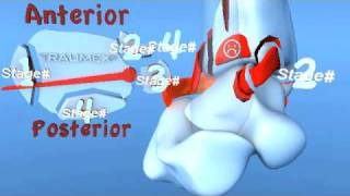 Lauge Hansen PER Pronation External Rotation Eversion Ankle Fracture [upl. by Nama]