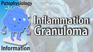 Granuloma  Granulomatous Inflammation شرح [upl. by Darell656]