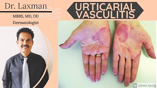 Urticarial Vasculitis  Vasculitis  Causes amp Symptoms amp Treatment Vasculitis Allergy Dermatology [upl. by Ahsatel455]