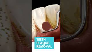 Teeth tartar cleaning  Health Go [upl. by Nerrawed318]