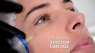 Carboxiterapia Ojeras y Cuello Sáez Medicina Estética Iquique [upl. by Yenots]