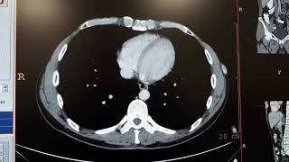 Hemangioma in liver ct [upl. by Rizzi465]