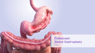 Endoscopic Sleeve Gastroplasty Animation Apollo ESG System [upl. by Jaquenette]