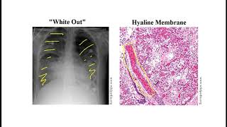 Video 242 Restrictive Lung Diseases Clinical Features Radiologic Findings Occupational Exposures [upl. by Ecnatsnok]