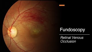 Retinal Venous Occlusion Fundoscopy [upl. by Raquela]