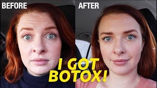 I Got Botox My Experience with Dr Dhir  Before and After [upl. by Dietz]