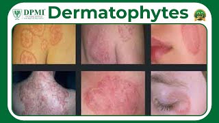 Dermatophyte Infection Types Of Dermatophytes Dermatophyte Symptoms Diagnosis And Treatment [upl. by Jordanson]