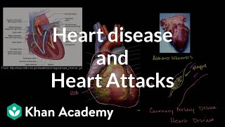 Heart disease and heart attacks  Miscellaneous  Heatlh amp Medicine  Khan Academy [upl. by Nyltac]