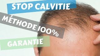 Calvitie Traitement Naturel ► Une Méthode 100 Naturelle [upl. by Aiuqenehs655]