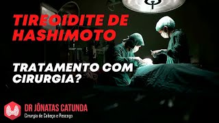 Tireoidite de Hashimoto é possível tratar com cirurgia [upl. by Moreville]