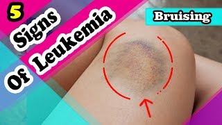 7 Signs and Symptoms You May Have a Leukemia [upl. by Bj]