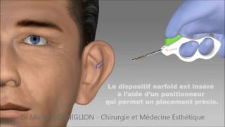 Earfold  une technique non chirurgicale pour les oreilles décollées  Dr Corniglion [upl. by Yokum]