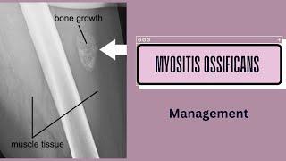 Management of Myositis Ossificans [upl. by Gnot756]