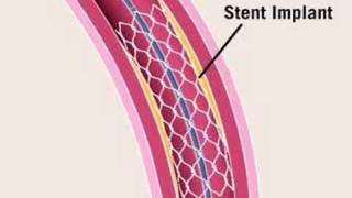 Angioplasty [upl. by Kamat]