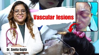 Alma IPL Laser is Best for Vascular Lesions संवहनी घावों के लिए उपचार क्या है [upl. by Salisbury]