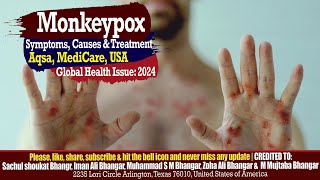 Monkeypox Virus Causes Symptoms Treatment and Prevention [upl. by Bonina]