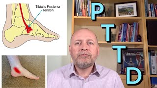 Posterior Tibial Tendon Dysfunction PTTD The best self help treatments [upl. by Horick]