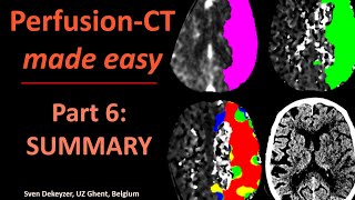 Perfusion CT made easy  part 6  Summary [upl. by Aryhs]