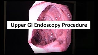 Upper GI Endoscopy Procedure in the ED [upl. by Ahsinehs246]