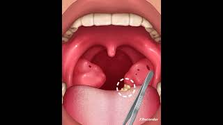 Asmr Tonsils Stones Removal [upl. by Robers104]