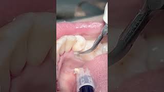 Scaling teeth tartar amp calculus dentist dental satisfying [upl. by Anaigroeg450]