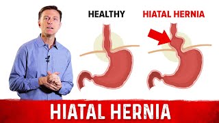 Quick Fix For Hiatal Hernia – Dr Berg [upl. by Siblee]