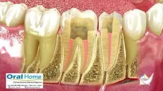 Endodoncia o tratamiento de conducto [upl. by Yasnil]