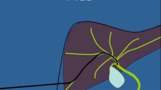 Biliary Stenting [upl. by Weywadt]