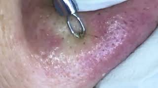 Extreme Satisfying Blackhead Removal 134  Acne Treatment [upl. by Ferriter547]