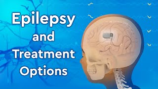 What is Epilepsy and How is it Treated [upl. by Gerhard]