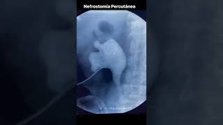 Nefrostomía Percutanea Radiologia Intervencionista [upl. by Irat701]