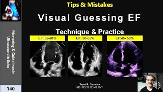 Visual Guessing Ejection Fraction Technique amp practice [upl. by Dymphia813]