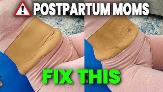 Diastasis Recti CONING How to Fix It in 3 Simple Steps [upl. by Aizirk]