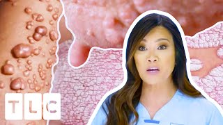 Dr Lees MOST Interesting Cases Mysterious Rashes Cysts amp More  Dr Pimple Popper [upl. by Lanfri853]