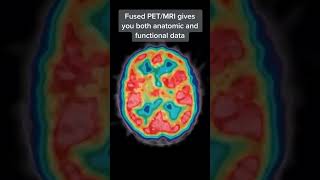 Nuclear medicine gives use beautiful images of brain function [upl. by Ajiam481]