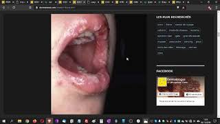 BOUTON DE FIEVRE ou HERPES LABIAL  Doc dermato vous informe sur le bouton de fievre [upl. by Careaga490]