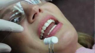 Invisalign Video Blog Bonding Attachments HD  Sierra 05 [upl. by Oirotciv]