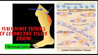 Fibrosarcoma Malignant neoplasms of connective tissue [upl. by Weisberg]