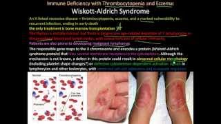 107P Severe Combined Immunodeficiency Wiskott Aldrich Syndrome [upl. by Rosenwald436]