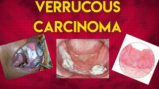 VERRUCOUS CARCINOMA [upl. by Guinevere509]