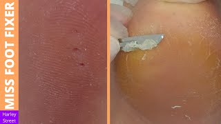 3 CORNS REMOVAL AND CRACKED HEELS TREATMENT BY Miss Foot Fixer [upl. by Fernanda12]