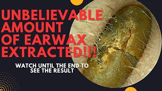 UNBELIEVABLE Amount Of Earwax Extracted From This Ear Watch Until The End [upl. by Lihcox]