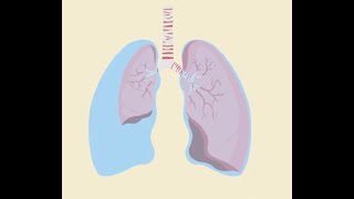 Tension Pneumothorax [upl. by Acimak]